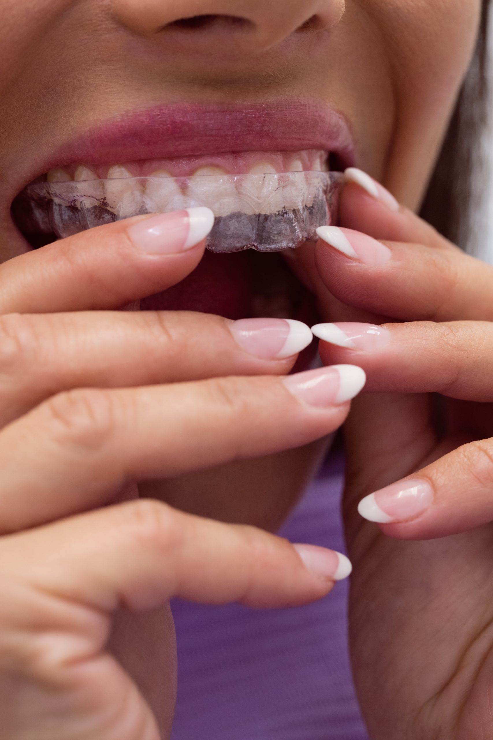 Close-up of female patient wearing braces in dental clinic